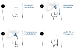 penisverlaengerung-muenchen-pd-dr-med-maximilian-eder.png