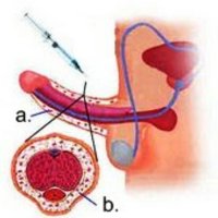 Penisverdickung m.Hyraluron.jpg