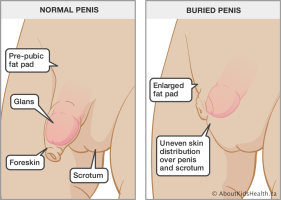 Buried_penis_MED_ILL_EN.png